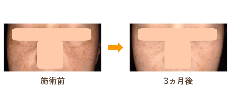 ケアシス（エレクトロポレーション） | 治療法から探す | 美容皮膚科